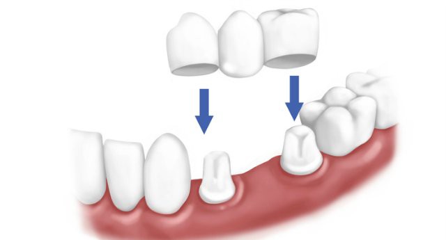 Prosthetics of teeth in the absence of a large number of teeth 