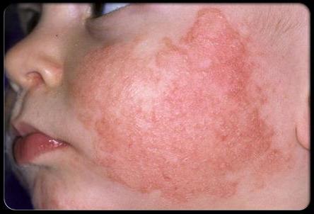 Sun Dermatitis