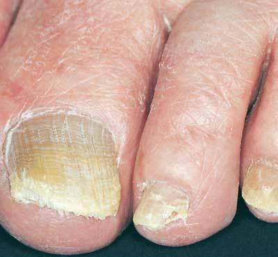 Remedies for nail fungus on legs: treatment and prevention