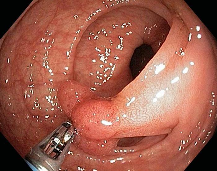tubular adenoma of the gut