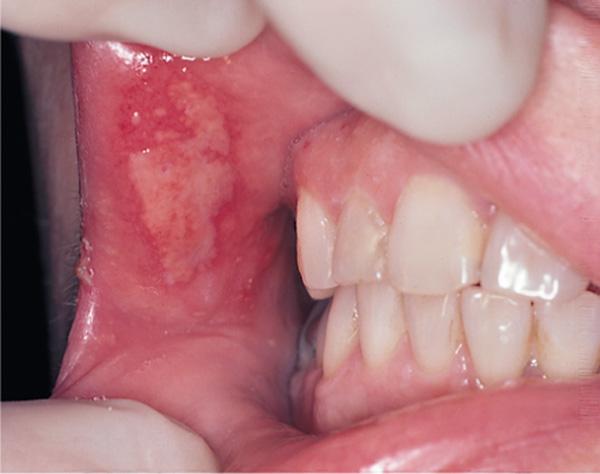 How to treat stomatitis