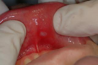 How much to treat stomatitis