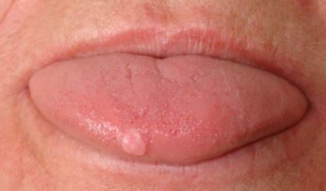 Inflammation of the papillae in the tongue