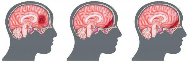 intracranial traumatic hematomas