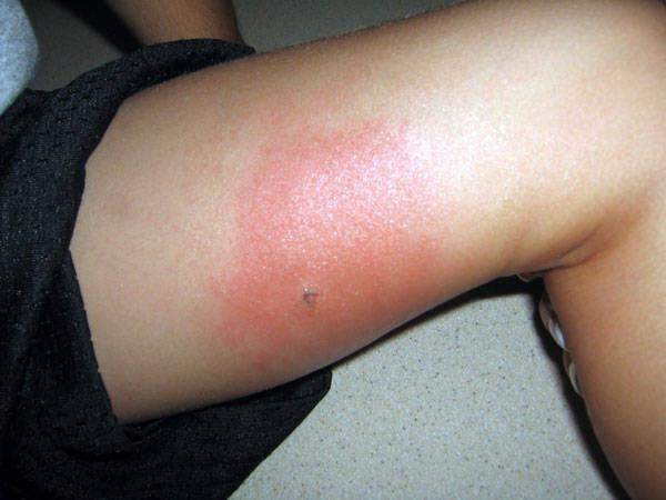 Question: why does the mosquito bite itch?