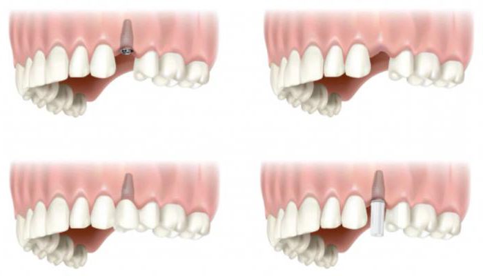 Teeth artificial: types and features